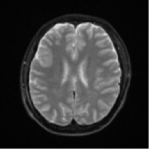 Acute left middle cerebral artery territory infarct with clot retrieval (Radiopaedia 47732-52433 Axial DWI 19).png