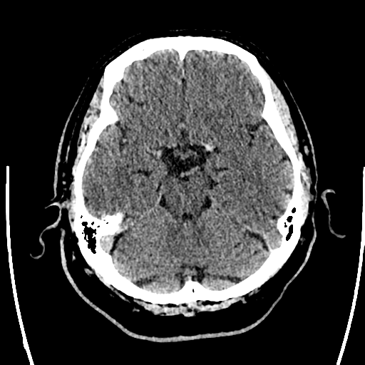 File:Acute left middle cerebral artery territory ischemic stroke (Radiopaedia 35688-37223 Axial non-contrast 26).png