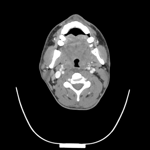 Acute longus colli calcific tendinitis (Radiopaedia 72495-83036 Axial C+ arterial phase 35).jpg