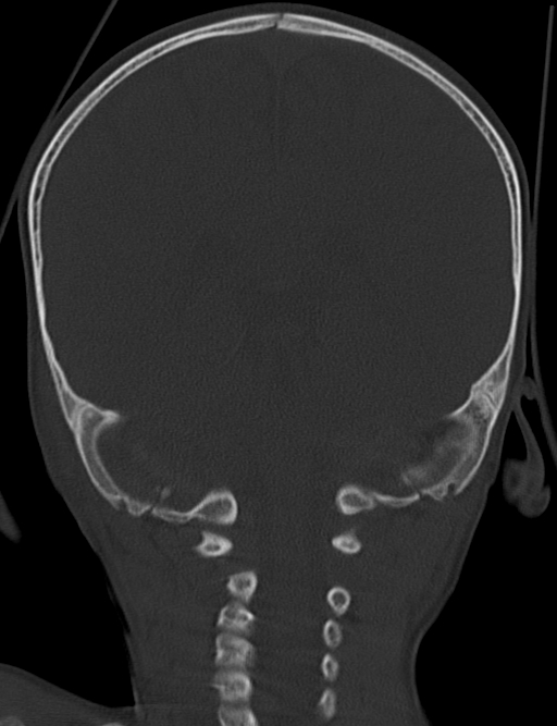 Acute mastoiditis (Radiopaedia 82678-96881 Coronal bone window 52).jpg