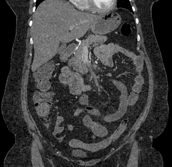 Acute mesenteric ischemia (Radiopaedia 80029-93316 Coronal C+ arterial phase 54).jpg