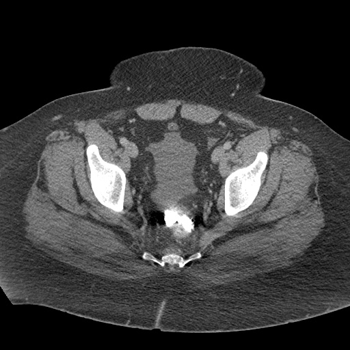 Acute mesenteric venous ischemia (Radiopaedia 46041-50383 Axial C+ portal venous phase 127).jpg