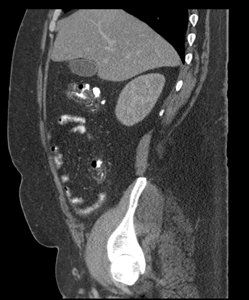 Acute mesenteric venous ischemia (Radiopaedia 46041-50383 Sagittal C+ portal venous phase 30).jpg