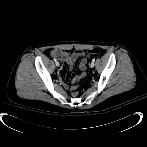 Acute myocardial infarction in CT (Radiopaedia 39947-42415 Axial C+ portal venous phase 110).jpg