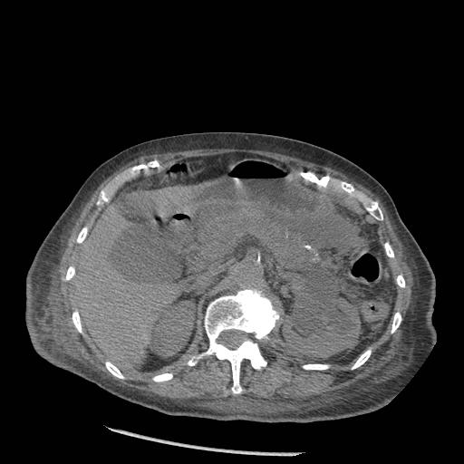 Acute on chronic pancreatitis (Radiopaedia 13233-13244 Axial non-contrast 30).jpg