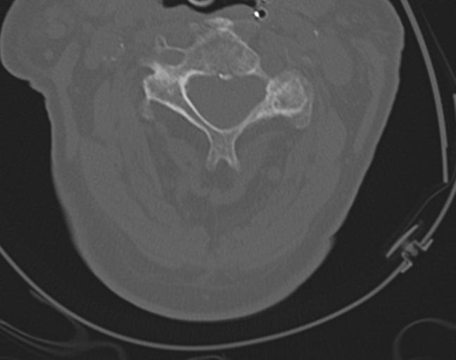 Acute on chronic subdural hematoma and thoracic vertebral injury in a multitrauma patient (Radiopaedia 31698-32619 Axial bone window 25).jpg