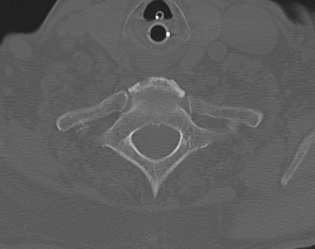 Acute on chronic subdural hematoma and thoracic vertebral injury in a multitrauma patient (Radiopaedia 31698-32619 Axial bone window 50).jpg