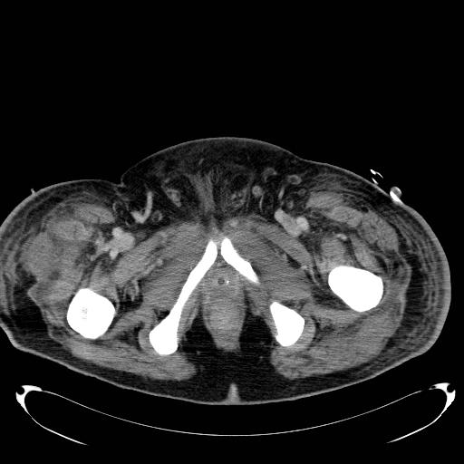 Acute pancreatic necrosis (Radiopaedia 13560-18503 Axial C+ portal venous phase 88).jpg