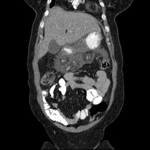 File:Acute pancreatitis (Radiopaedia 20829-20744 Coronal C+ portal venous phase 15).jpg