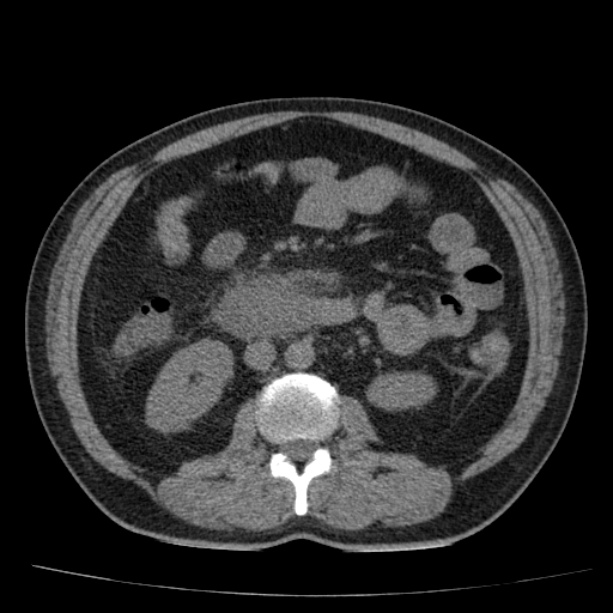 Acute pancreatitis (Radiopaedia 26663-26813 Axial non-contrast 51).jpg