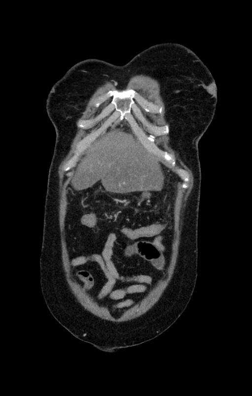 Acute pancreatitis (Radiopaedia 80007-93285 Coronal C+ portal venous phase 14).jpg