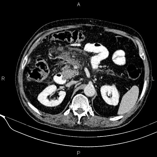 Acute pancreatitis (Radiopaedia 85146-100701 Axial C+ portal venous phase 26).jpg