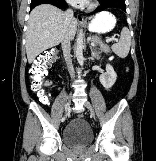 Acute pancreatitis (Radiopaedia 85390-101010 Coronal C+ portal venous phase 40).jpg