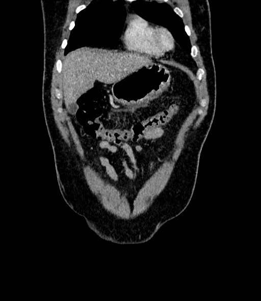 Acute pancreatitis (Radiopaedia 87428-103757 Coronal C+ portal venous phase 16).jpg