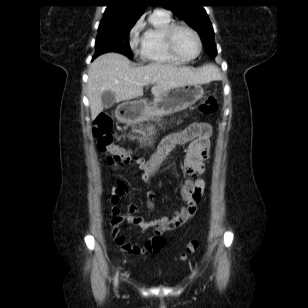 Acute pancreatitis - Balthazar C (Radiopaedia 26569-26714 Coronal C+ portal venous phase 23).jpg