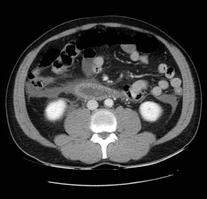 Acute pancreatitis - Balthazar E (Radiopaedia 23080-23110 Axial C+ portal venous phase 37).jpg