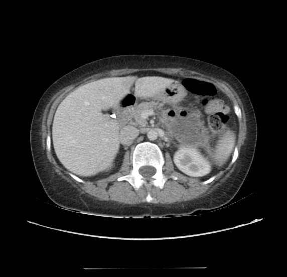 File:Acute pancreatitis - Balthazar E - post ERCP (Radiopaedia 27562-27772 Axial C+ portal venous phase 27).png