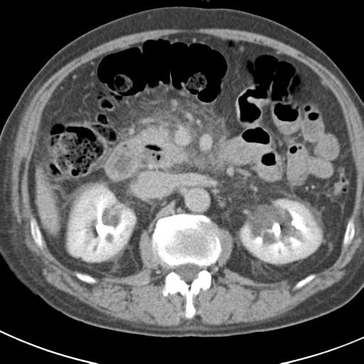 Acute pancreatitis and walled-off necrosis (Radiopaedia 29888-30403 Axial C+ delayed 34).jpg