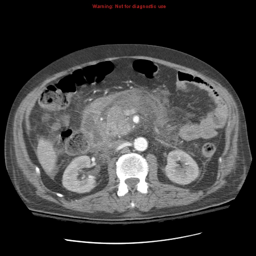 Acute pancreatitis with incidental pancreatic lipoma (Radiopaedia 10190-10730 Axial C+ arterial phase 46).jpg