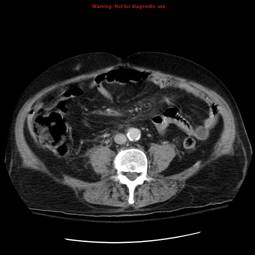 File:Acute pancreatitis with incidental pancreatic lipoma (Radiopaedia 10190-10730 Axial C+ portal venous phase 47).jpg