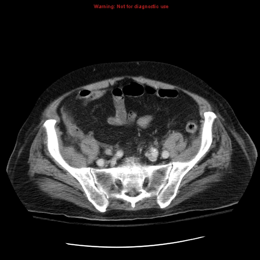 File:Acute pancreatitis with incidental pancreatic lipoma (Radiopaedia 10190-10730 Axial C+ portal venous phase 60).jpg