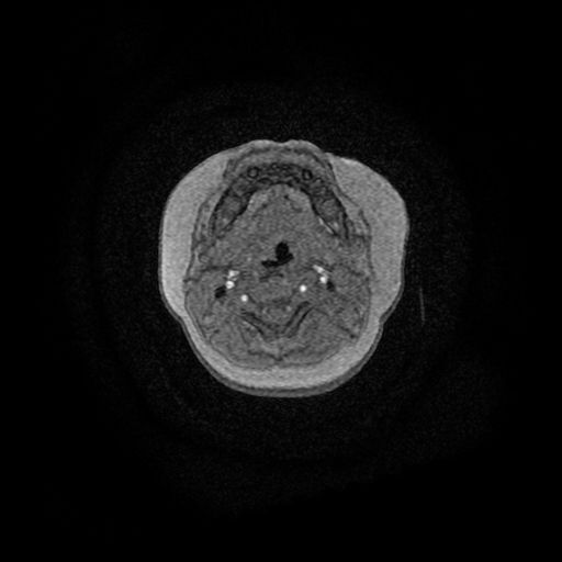 File:Acute phase of hemiconvulsion-hemiplegia epilepsy syndrome (Radiopaedia 29309-29745 Axial TOF angiography 187).jpg