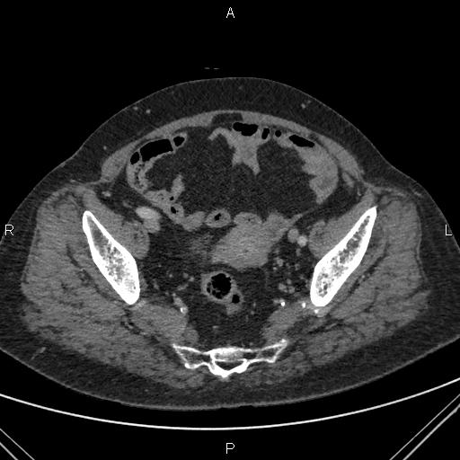 File:Acute renal artery occlusion (Radiopaedia 86586-102682 Axial C+ portal venous phase 83).jpg