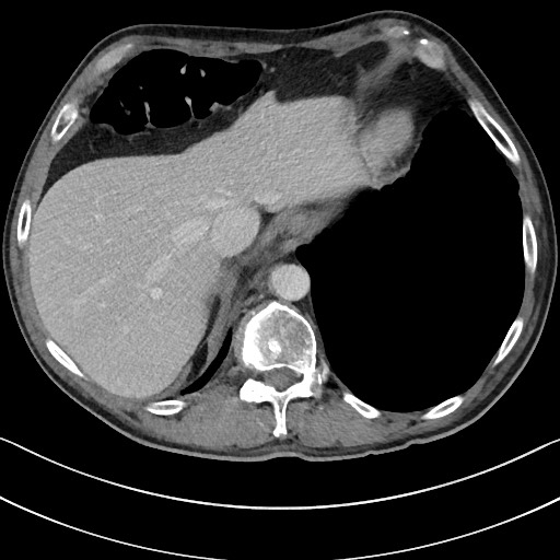 Acute renal infarction - rim capsular enhancement (Radiopaedia 59833-67270 Axial C+ portal venous phase 16).jpg