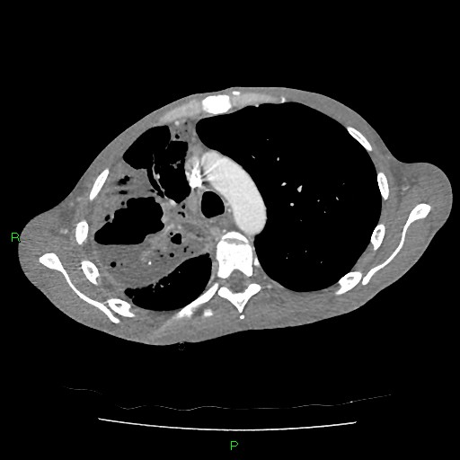 File:Acute right lung abscess (Radiopaedia 34806-36258 Axial C+ arterial phase 57).jpg