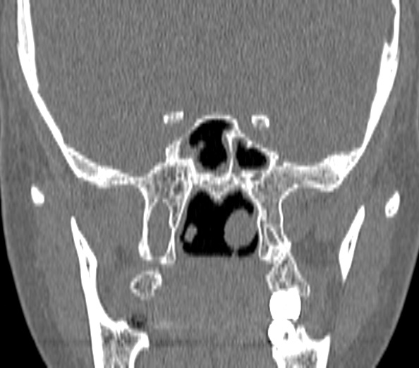 Acute sinusitis (Radiopaedia 40564-43158 Coronal bone window 36).jpg