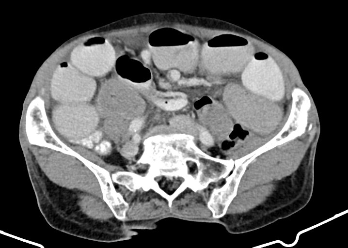 Acute small bowel (ileal) volvulus (Radiopaedia 71740-82139 Axial C+ portal venous phase 141).jpg