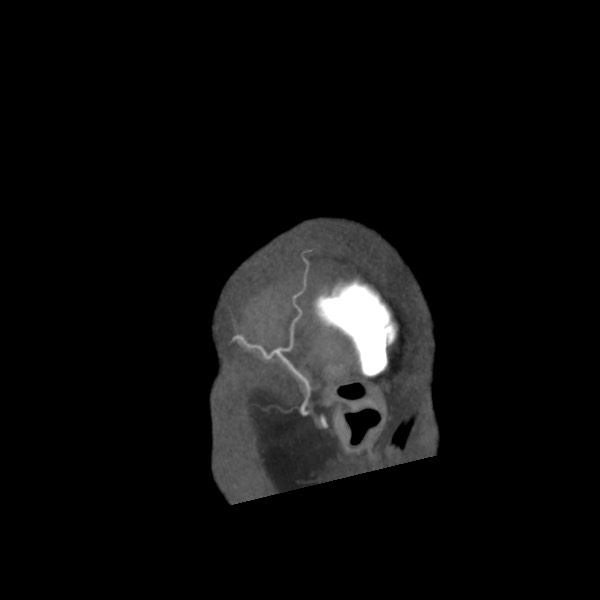 Acute subarachnoid hemorrhage and accessory anterior cerebral artery (Radiopaedia 69231-79009 Sagittal C+ arterial phase 70).jpg