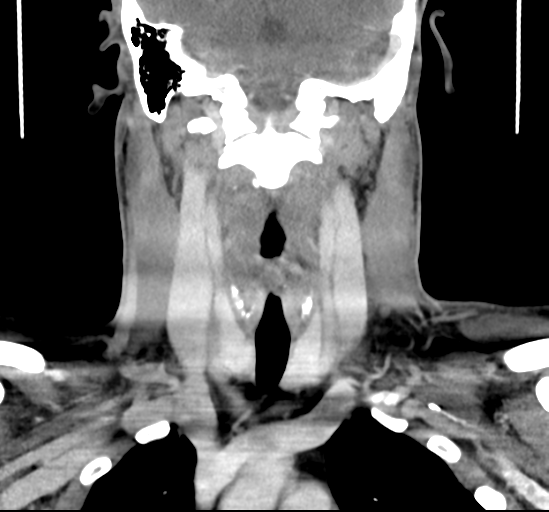 Acute tonsillitis (Radiopaedia 33913-35111 Coronal C+ delayed 42).png