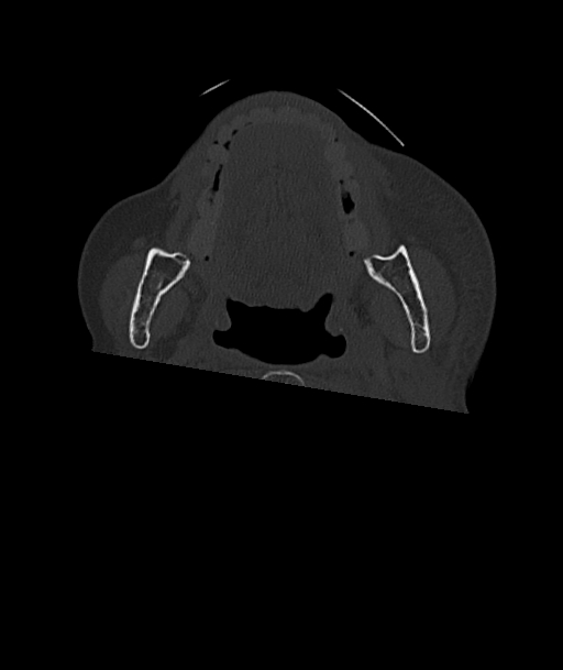 Acute traumatic subdural hematoma (Radiopaedia 82921-97257 Axial bone window 119).jpg