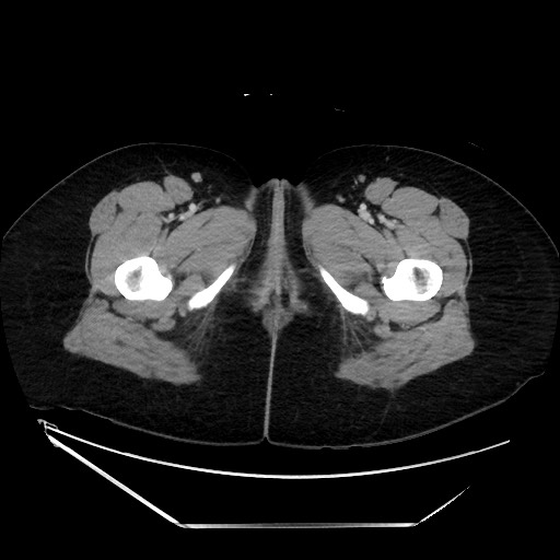 File:Acute uncomplicated appendicitis (Radiopaedia 73704-84499 Axial C+ portal venous phase 180).jpg