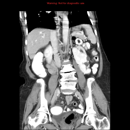 File:Adenocarcinoma of the colon (Radiopaedia 8191-9039 Coronal liver window 27).jpg