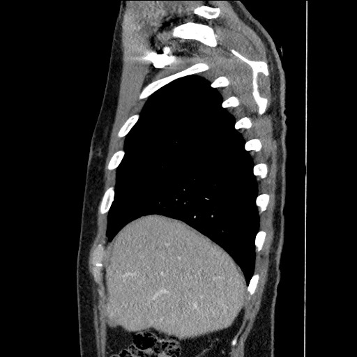 Adenocarcinoma of the lung (Radiopaedia 59871-67325 Sagittal C+ arterial phase 14).jpg