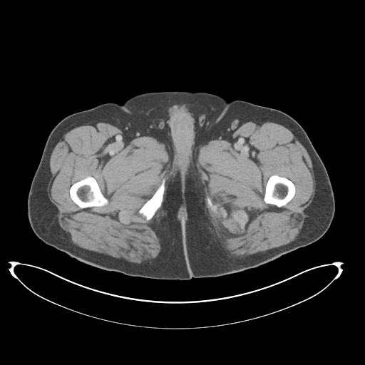 File:Adenocarcioma of rectum- T1 lesion (Radiopaedia 36921-38547 Axial C+ portal venous phase 99).png