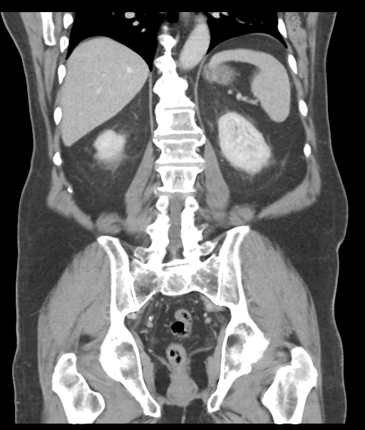 Adenocarcioma of rectum- T1 lesion (Radiopaedia 36921-38547 Coronal C+ portal venous phase 44).png