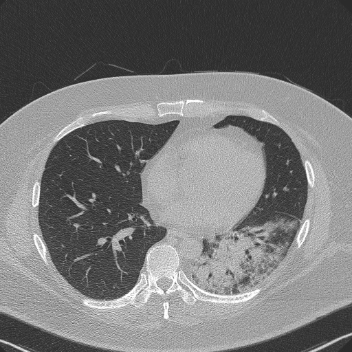 Adenoid cystic carcinoma of the trachea (Radiopaedia 49042-54137 Axial lung window 217).jpg