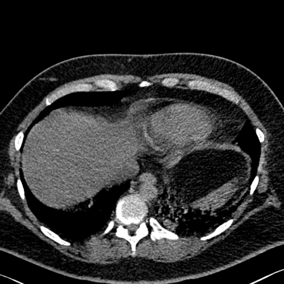 File:Adenoid cystic carcinoma of the trachea (Radiopaedia 49042-54137 Axial non-contrast 279).jpg