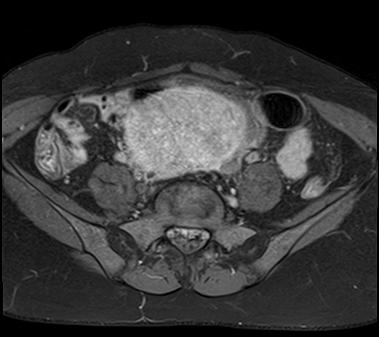 File:Adenomyosis - ovarian endometriomas (Radiopaedia 67031-76350 Axial T1 C+ fat sat 6).jpg