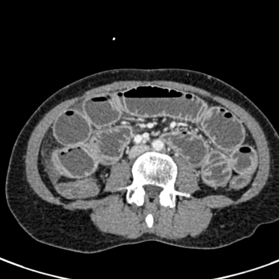File:Adhesional small bowel obstruction (Radiopaedia 48397-53305 Axial C+ portal venous phase 48).jpg
