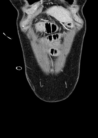 Adhesional small bowel obstruction (Radiopaedia 48397-53305 Coronal C+ portal venous phase 40).jpg