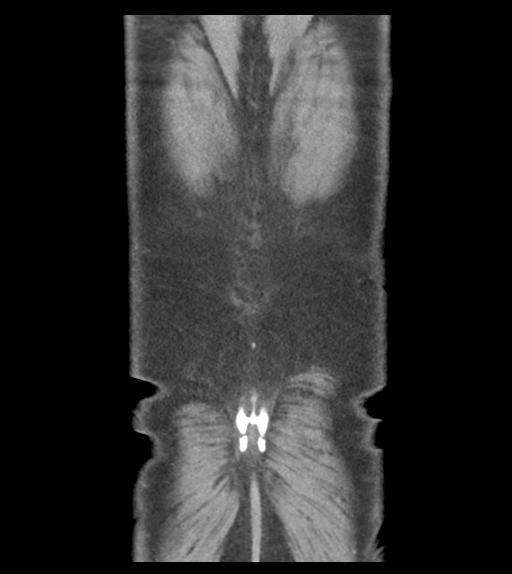 Adhesions within abdominal wall hernia (Radiopaedia 58283-65394 Coronal C+ portal venous phase 65).png