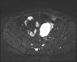 File:Adnexal multilocular cyst (O-RADS US 3- O-RADS MRI 3) (Radiopaedia 87426-103754 Axial DWI 7).jpg