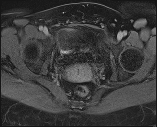 File:Adnexal multilocular cyst (O-RADS US 3. O-RADS MRI 3) (Radiopaedia 87426-103754 Axial 236).jpeg