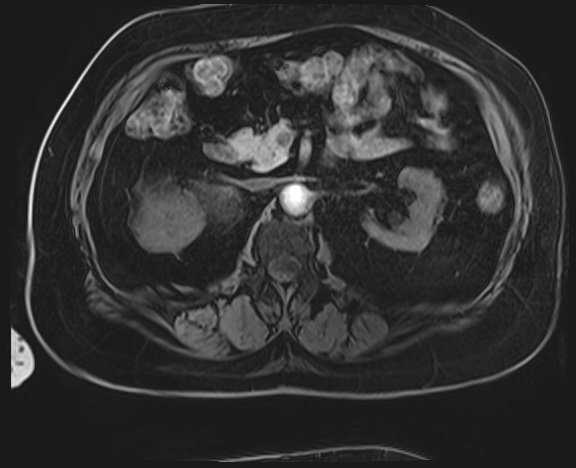 Adrenal cortical carcinoma (Radiopaedia 64017-72770 Axial T1 C+ fat sat 20).jpg