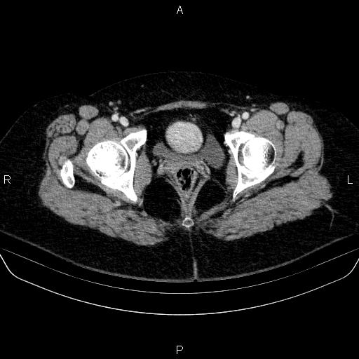 Adrenal cortical carcinoma (Radiopaedia 84882-100379 Axial C+ portal venous phase 93).jpg
