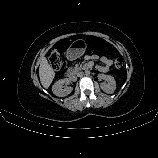 File:Adrenal cortical carcinoma (Radiopaedia 84882-100379 Axial non-contrast 37).jpg